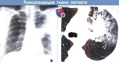 Участок легочной ткани