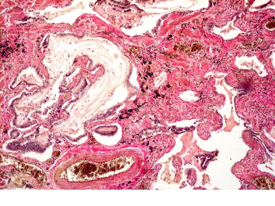 Альвеолиты рекомендации. Экзогенный аллергический альвеолит микропрепарат. Фиброзирующий альвеолит гистология. Экзогенный аллергический альвеолит гистология. Токсическом альвеолит гистология.