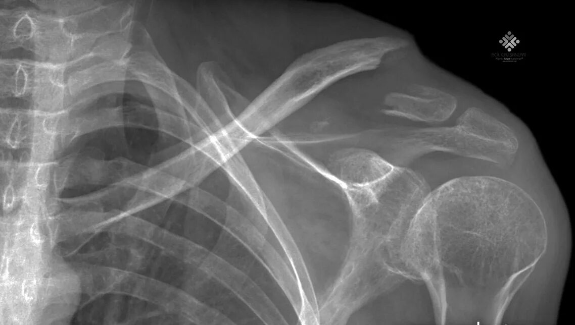 Поднадкостничный перелом ключицы. Рентгеновский снимок перелома ключицы. Fractured collarbone. Перелом ключицы со смещением рентген. Fractured collarbone.