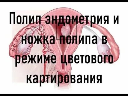 Полип в матке психосоматика