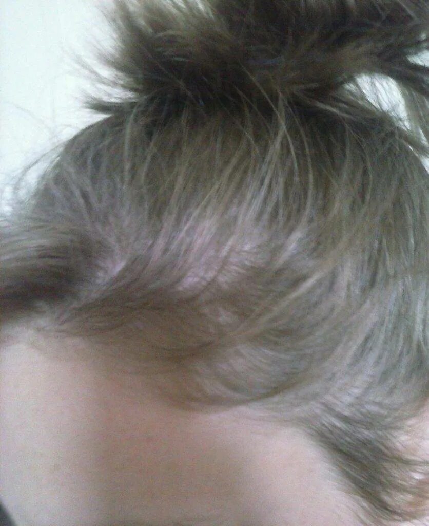 выпадение волос у женщин после 30. редеют волосы. выпадение волос у женщин после 30. выпадение волос за ушами. редкие волосы у женщин.