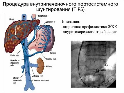 Синдром шунтирования печени