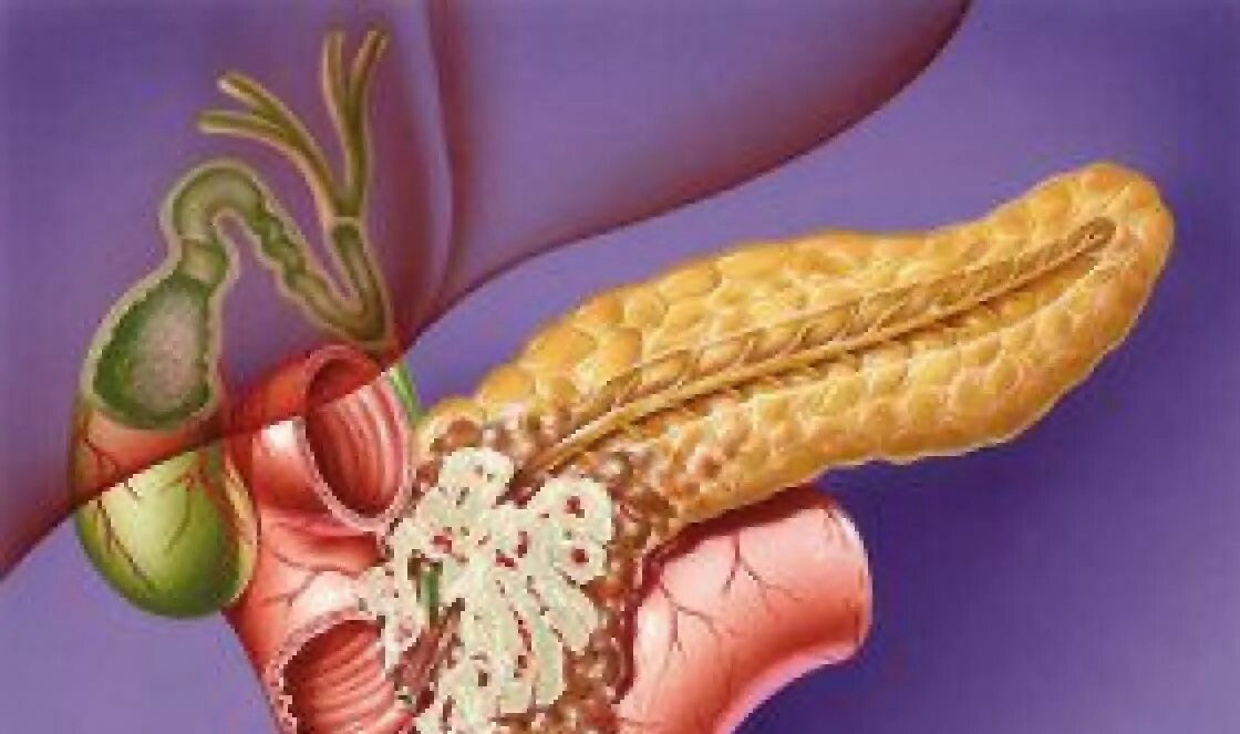 Лечение опухоли поджелудочной. Опухоль поджелудочной. Поджелудочная железа человека. Аденокарцинома поджелудочной железы.