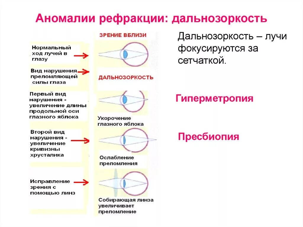 Недостатки дальнозоркости. Гиперметропия у детей клинические рекомендации. Аномалии рефракции глаза близорукость дальнозоркость таблица. Коррекция гиперметропии у детей клинические рекомендации. Аномалии рефракции глаза близорукость дальнозоркость астигматизм.