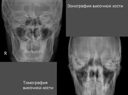 Рентген височно