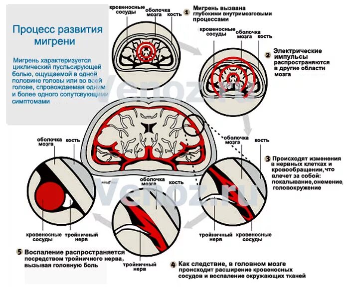 Лечение болезней головного мозга. Мигрень механизм возникновения. Мигрень головного мозга. Механизм возникновения головной боли. Мигрень схема.