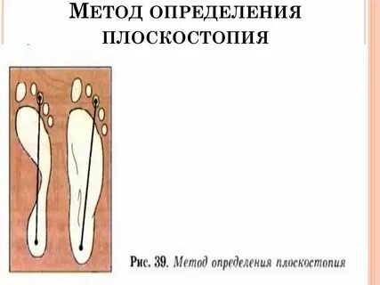 Выявление плоскостопия лабораторная