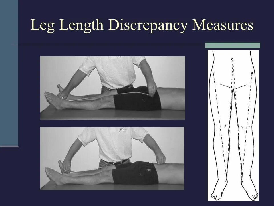 Thigh hip разница. Leg length. Subischial Leg length. Leg length different.