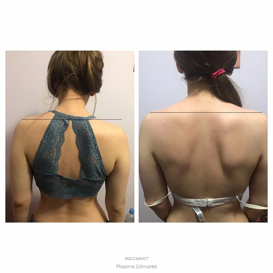 асимметрия спины