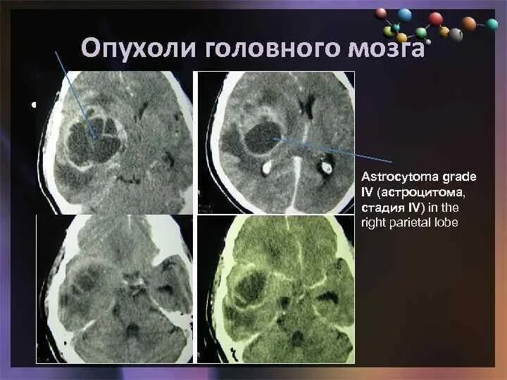 Образование головного мозга код по мкб. Кт диагностика опухолей головного мозга. Опухоль головного мозга астроцитома. Объемное образование головного мозга диагноз.