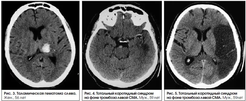 ОНМК В бассейне левой средней мозговой. Инсульт в бассейне средней мозговой артерии кт. Таламическая гематома кт. Инсульт в бассейне средней мозговой артерии.