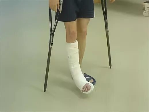 сколько ходят в гипсе при переломе. ортез при переломе 5 плюсневой кости стопы fs 2822. перелом пястной кости гипс. костыль при переломе лодыжки. сколько ходят в гипсе при переломе.