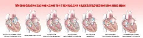 Тахикардия операция