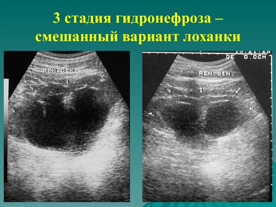 Гидронефроз 3 степени УЗИ. Гидронефротическая трансформация почки на УЗИ. Расширение почечной лоханки на УЗИ. Расширение лоханки почки на УЗИ.