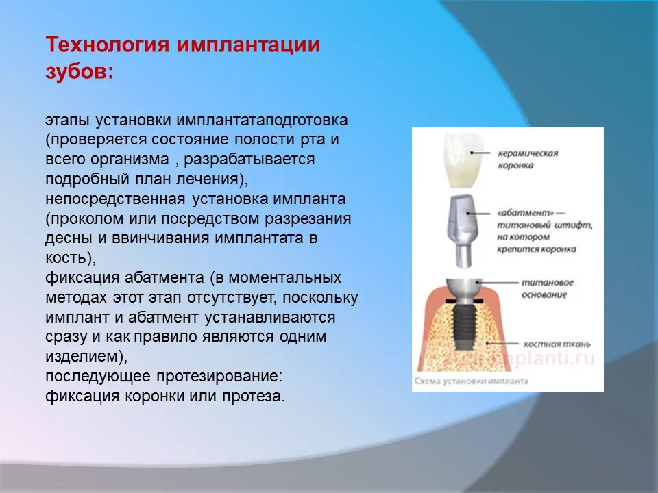 Этапы установки импланта зуба. Этапы имплантации зубов. этапы установки имплантов. этапы установки имплантата.