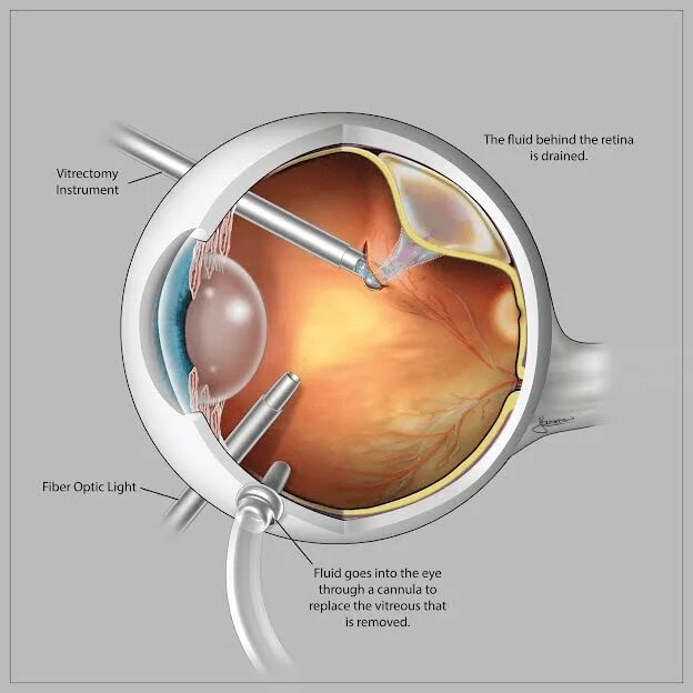 Отслойка сетчатки витрэктомия. Витреоретинальная операция сетчатки глаза. Витреоретинальная хирургия. Операция витрэктомия глаза.