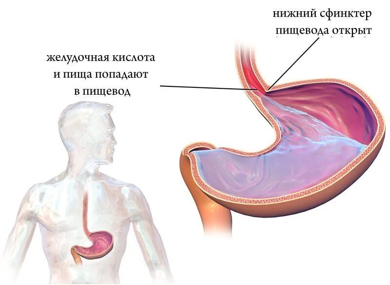 Желудочный сок в пищеводе