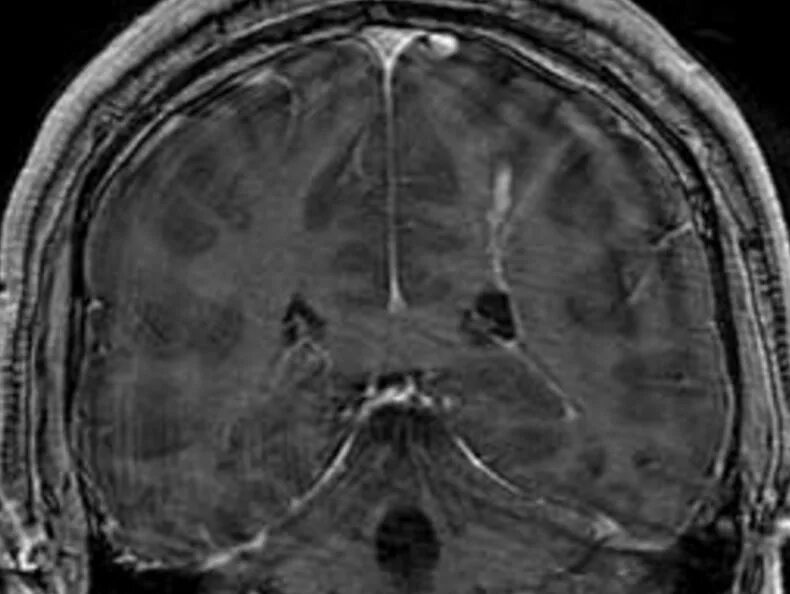 Кавернозная ангиома головного. Ангиома сосудов головного мозга. Венозная ангиома головного мозга мрт. Ангиома головного мозга кт. Ангиома правой лобной доли