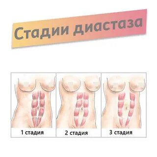 Диастаз грудины