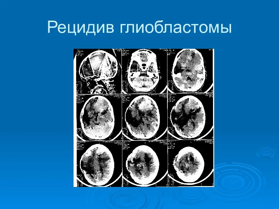 Глиобластома рецидив мрт. Стадии развития глиобластомы. Вероятность рецидива глиобластомы.