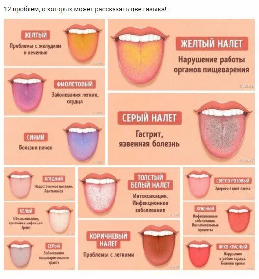 Неприятное название. Заболевания по цвету языка. Нормальное состояние языка. Болезни по языку определить.