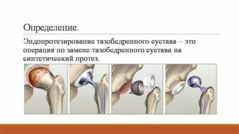 Осложнения после замены тазобедренного сустава