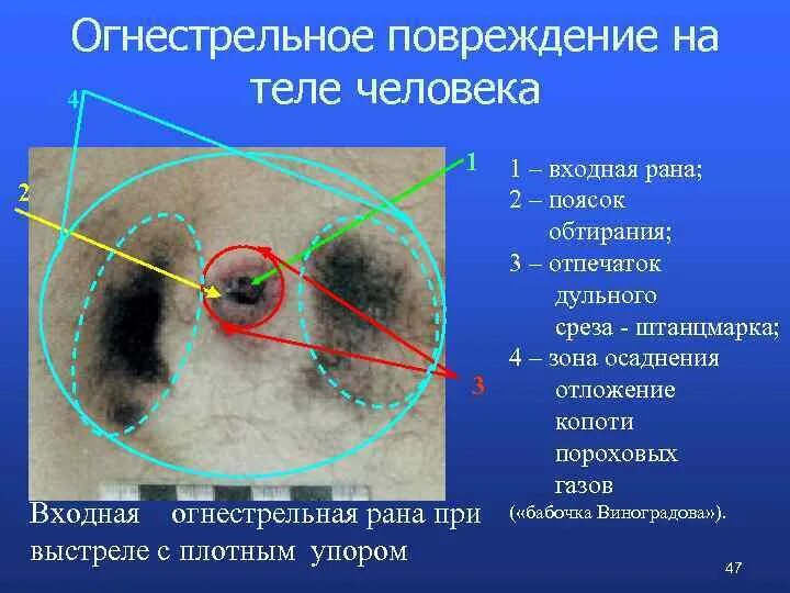 Сквозная огнестрельная рана. Входное огнестрельное ранение. Поясок осаднения огнестрельное ранение.