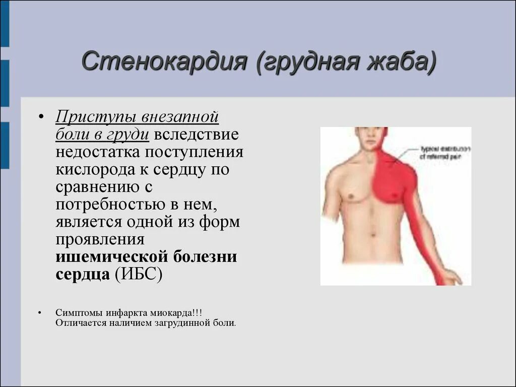 Грудная жаба симптомы. Стенокардия боль за грудиной. От чего может болеть грудная клетка