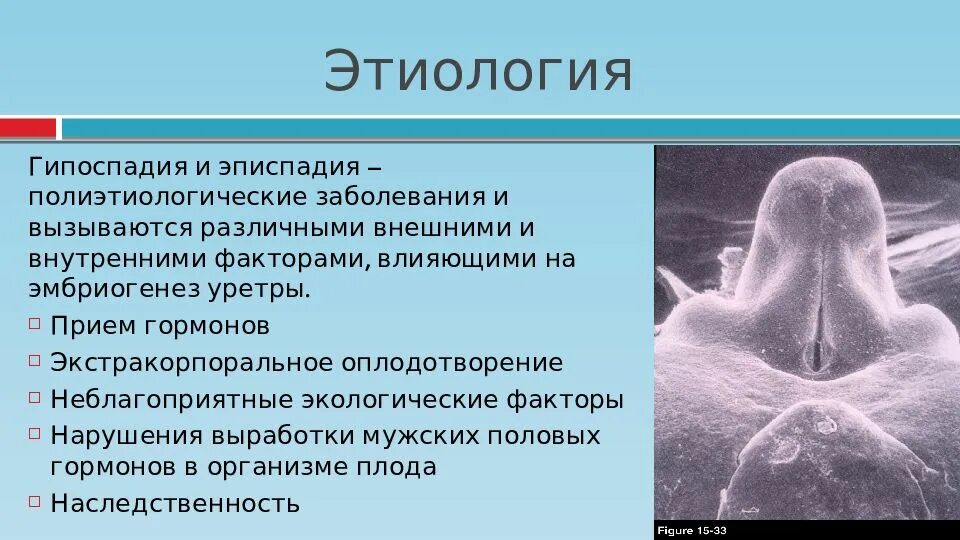 Эписпадия