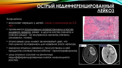 Печень при остром лейкозе