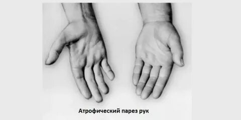Парез руки