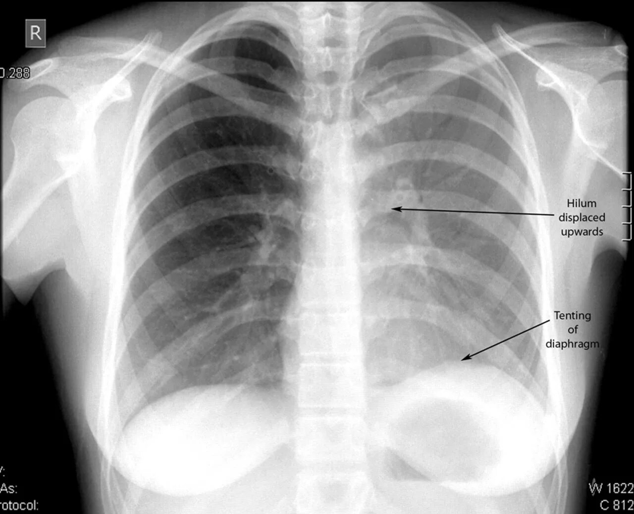 Туберкулезная эмпиема латынь. Atelectasis x ray. Atelectasis XRAY.