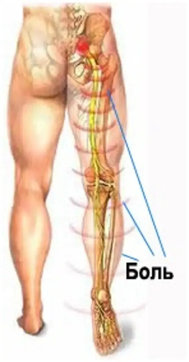 Седалищный в пояснице. Седалищный нерв и грыжа l5 s1. Защемление седалищного нерва s1.