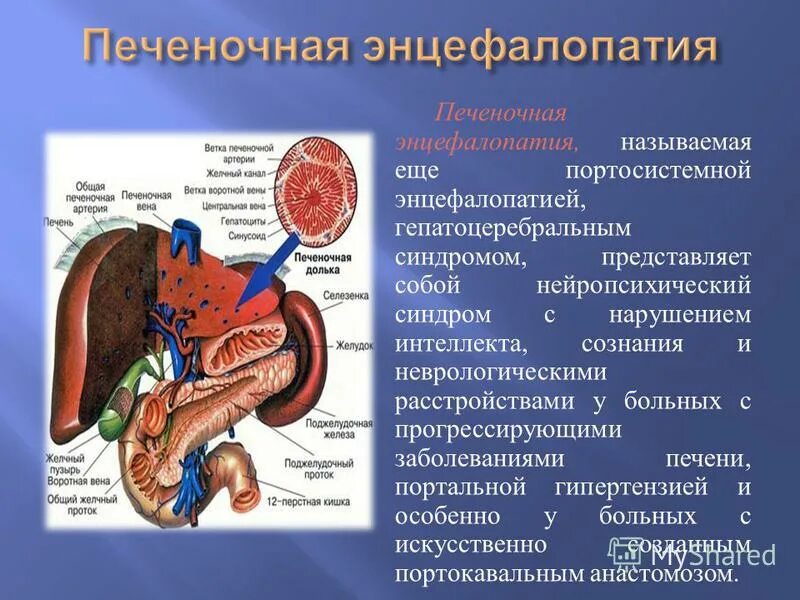 Энцефалопатия печени. Печеночная энцефалопатия энцефалопатия. синдром печеночной энцефалопатии классификация. печеночная энцефалопатия развивается вследствие. синдром гепатоцеребральной недостаточности патогенез.