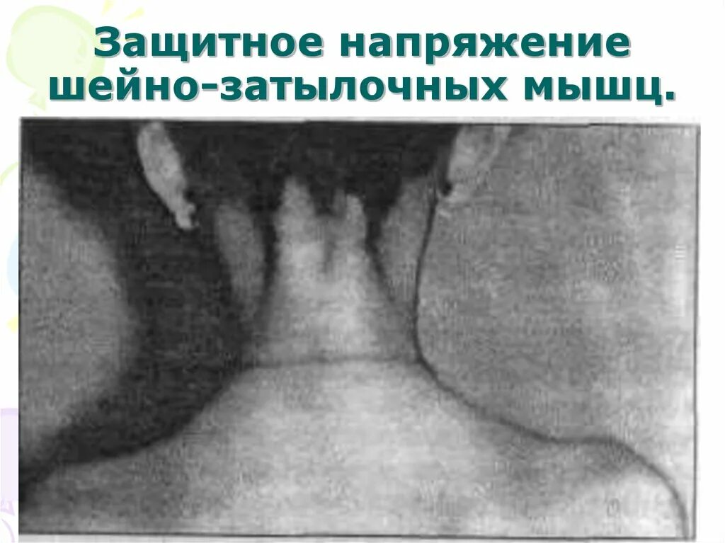 Шейная ригидность. Защитное напряжение шейно-затылочных мышц. напряженность затылочных мышц. затылочные мышцы. ригидность затылочных мышц.