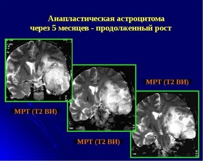 Астроцитома grade 3