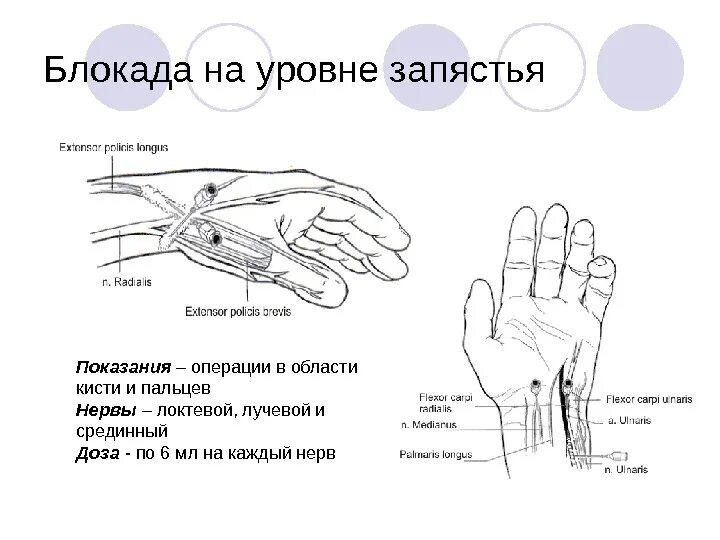 Нервная блокада. Проводниковая анестезия запястья. Проводниковая анестезия лучезапястного сустава. Проводниковая анестезия локтевого и лучевого нерва. Блокада кисти на уровне лучезапястного сустава.