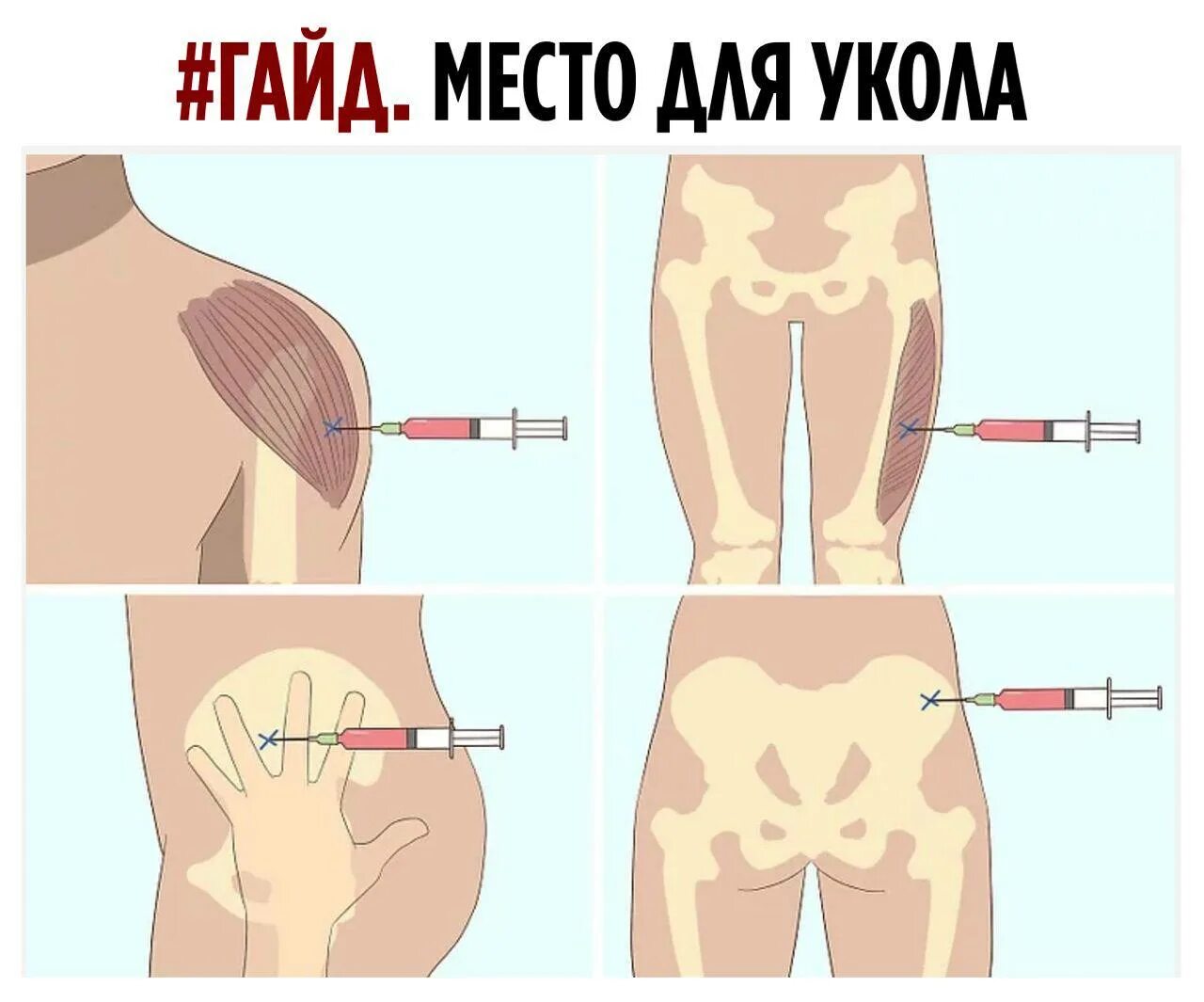 Колят плечи. Правильно поставить укол внутримышечно. Как правильно сделать укол внутримышечно. Подкожно внутрикожно внутримышечно.