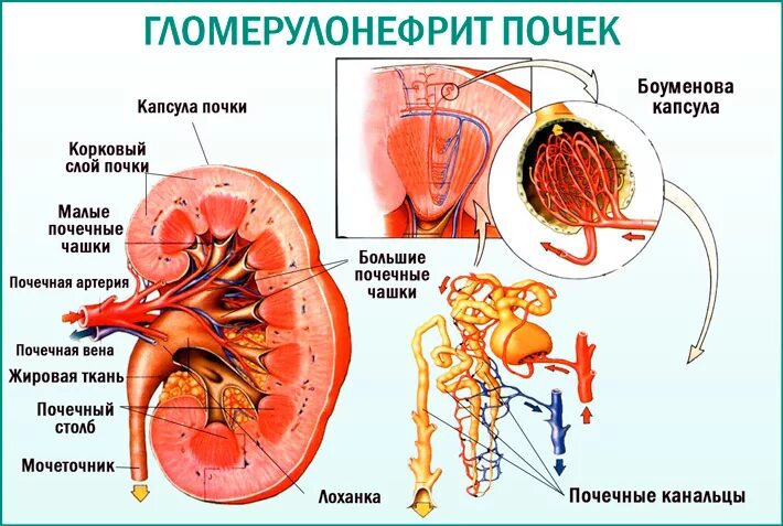 Заболевание почек гломерулонефрит. Острый почечный гломерулонефрит. Гломерулонефрит почечный клубочек. Почка пораженная гломерулонефритом. Поражение клубочков гломерулонефрит.