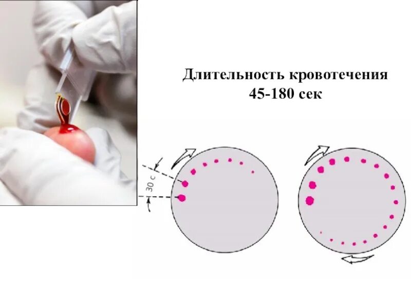 Кровь на длительность кровотечения. Длительность кровотечения по Дьюку норма. Длительностькоовотечения. Длительность кровотечения по Дуке норма. Измерение длительности кровотечения по Дуке.