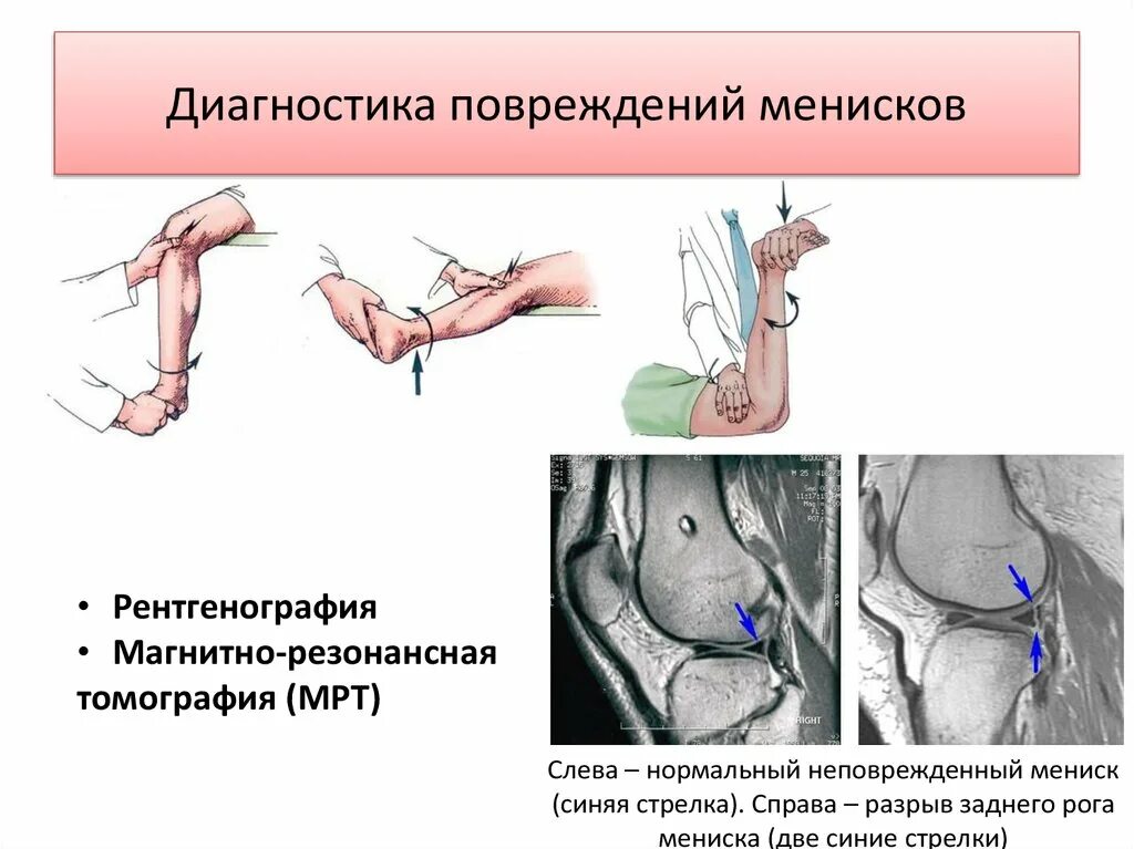 Повреждение мениска диагноз. Диагноз разрыв мениска. Повреждение медиального мениска диагностика. Диагностика разрыва мениска. Симптом байкова