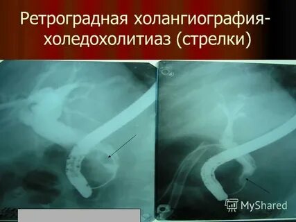Холедохолитиаз история болезни