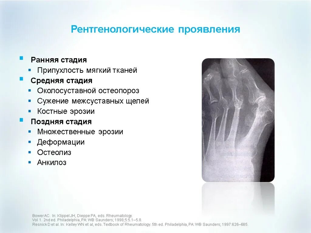 Рентгенологические симптомы ревматоидного артрита. Ревматоидный артрит симптомы рентген. Характерные рентгенологические признаки ревматоидного артрита. Ревматоидный артрит рентген стадии. Артрит рентгенологические стадии