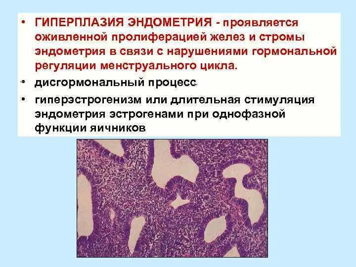 Неатипическая гиперплазия эндометрия. Очаговая гиперплазия форум. Клинические проявления гиперплазии эндометрия:. Гиперпластические процессы эндометрия патогенез. Атипическая гиперплазия эндометрия полипоз.