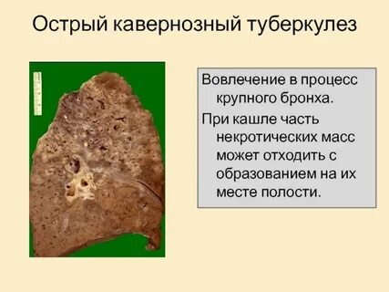 Каверна это