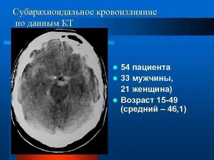 Субарахноидальный инсульт