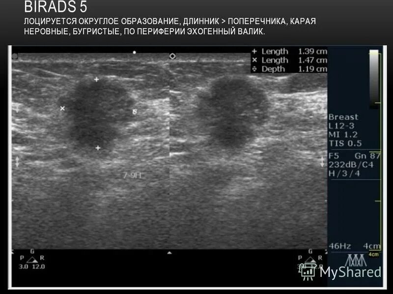 Bi rads 3 узи. Фибролипома молочной железы УЗИ. УЗИ снимки фиброаденомы молочной железы. Фиброаденома молочной железы УЗИ анатомия. Фиброаденома молочной железы birads 4 УЗИ.