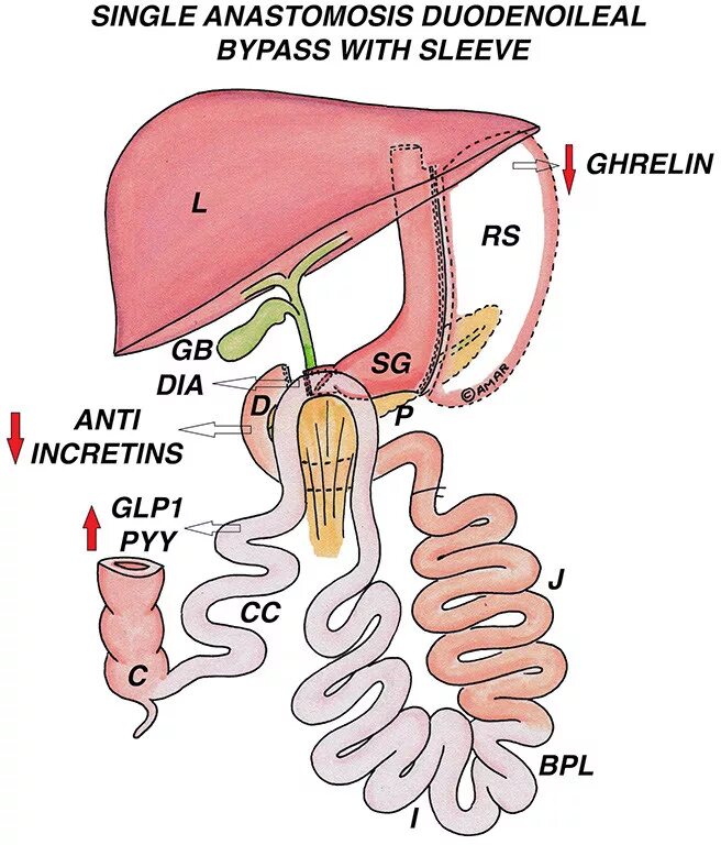 Анастомоз пищевода. Бариатрическая операция Sadi что это.