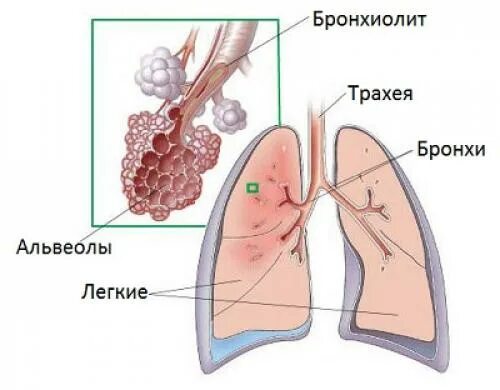 Бронхиолит причины. Респираторный бронхиолит. облитерирующий бронхиолит. бронхиолит заболевание.