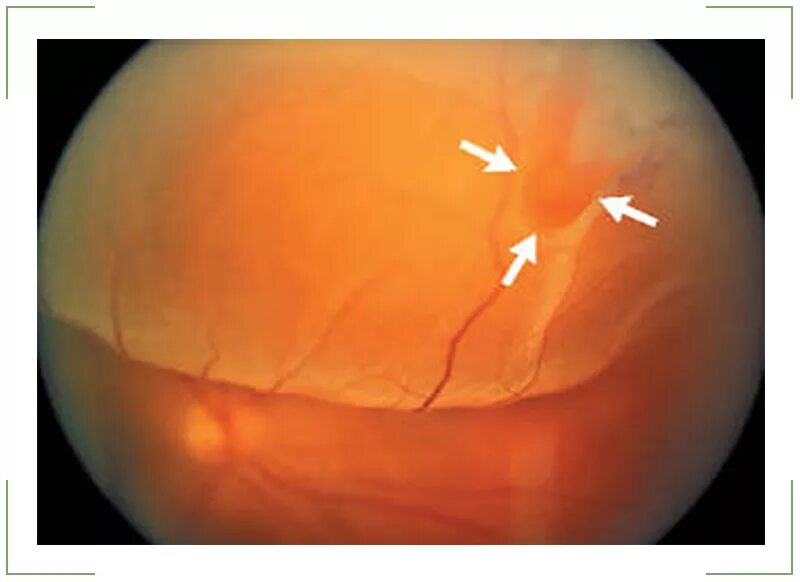 Неопластическая отслойка сетчатки. Нерегматогенная отслойка сетчатки. Свежая регматогенная отслойка сетчатки. Регматогенная отслойка сетчатки офтальмоскопия. Повреждение сетчатки